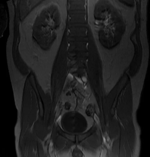 psoas localizer image 1 - MRI