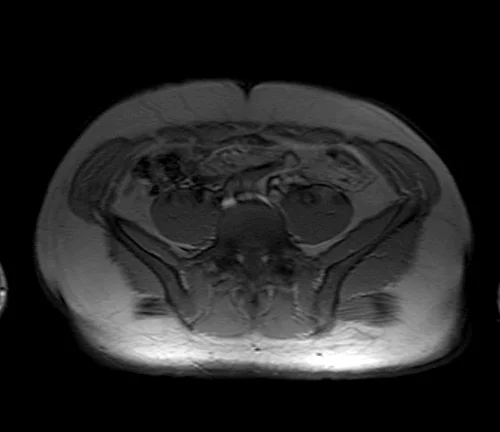 psoas localizer image 3 - MRI
