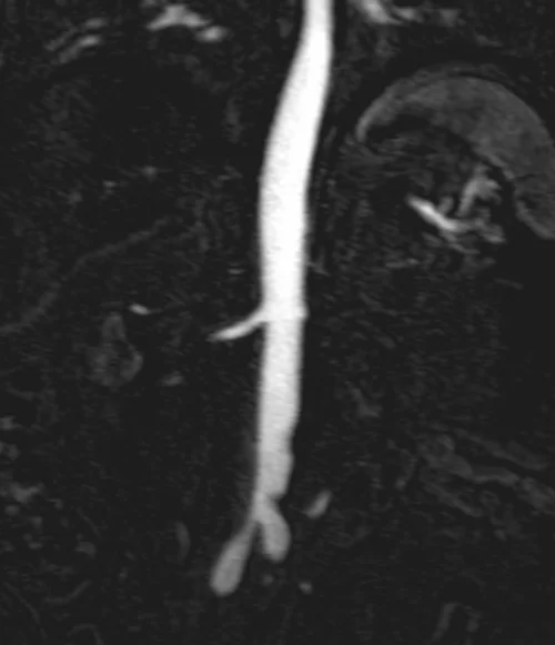 renal angiography substraction image 2 - MRI