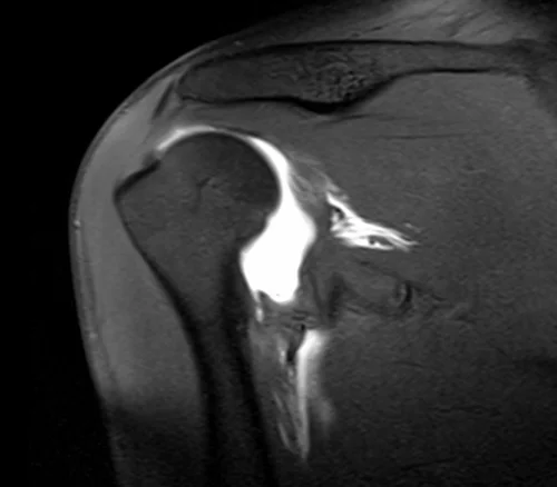 shoulder arthrogram coronal t1 fat sat image 1 - MRI