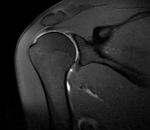 shoulder arthrogram coronal t1 fat sat image 2 - MRI