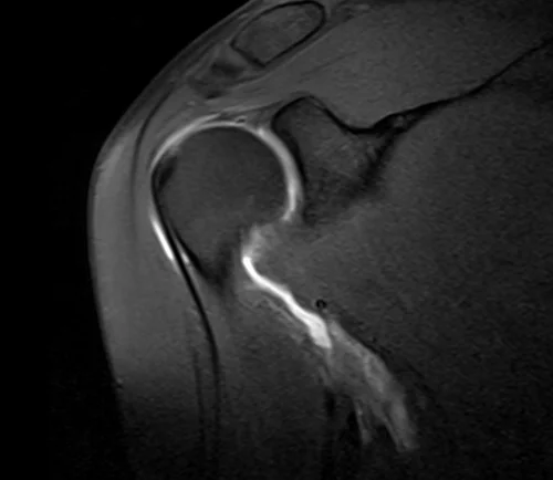 shoulder arthrogram coronal t1 fat sat image 3 - MRI
