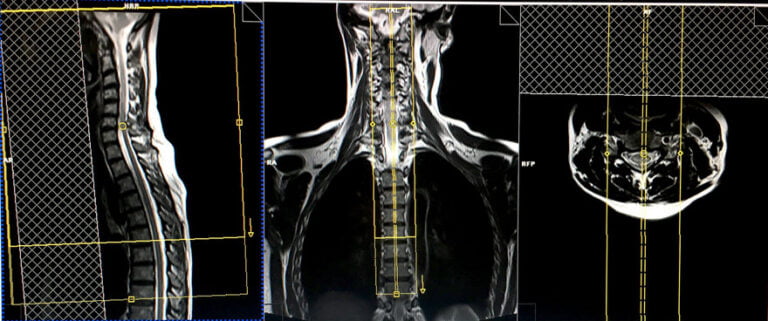 spinal cord mri protocols, planning and indications | multiple ...