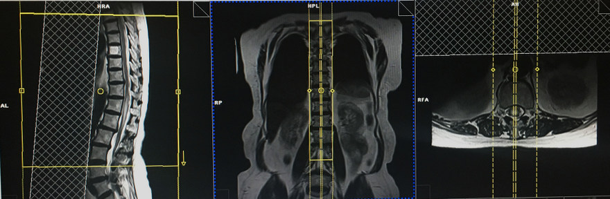 Multiple sclerosis (MS) MRI protocol and planning | MS MRI brain and ...