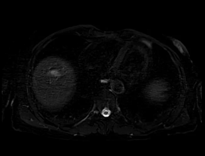 stir 1 - MRI