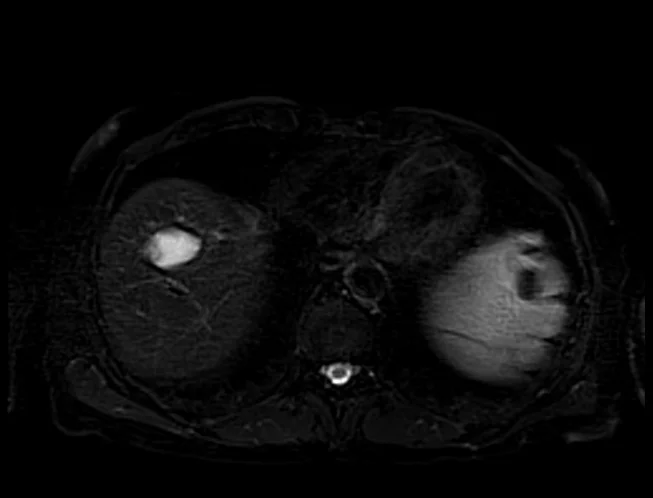 stir 2 - MRI
