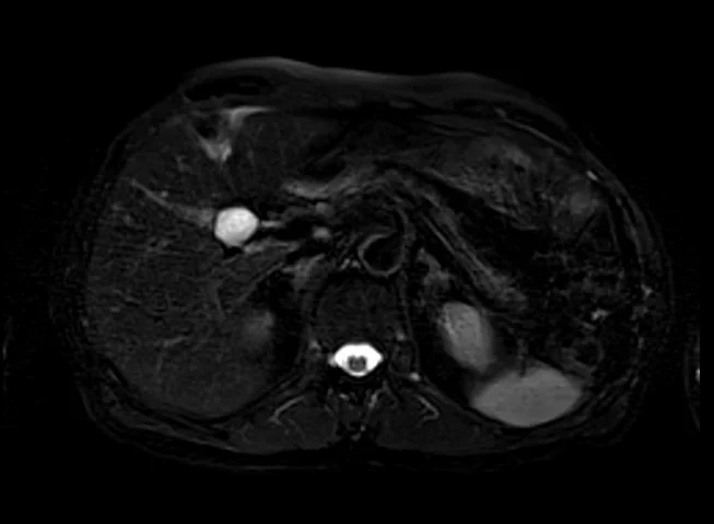 stir 3 - MRI