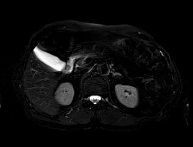 stir 4 - MRI