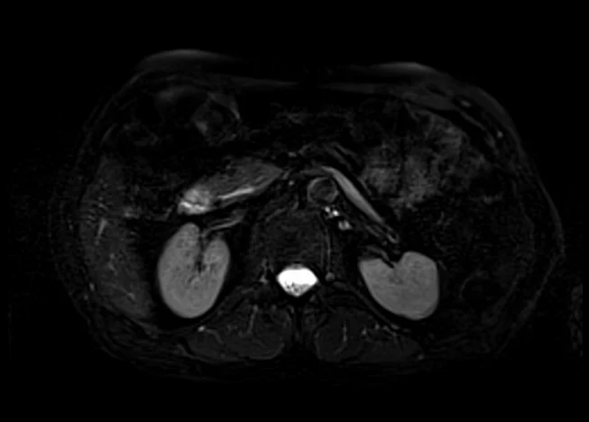 stir 5 - MRI