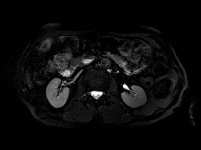 stir 6 - MRI