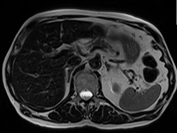 t2 180 3 - MRI