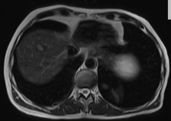 t2 90 1 - MRI