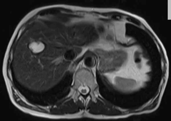 t2 90 2 - MRI