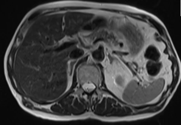 t2 90 3 - MRI