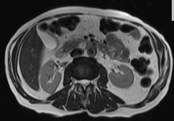t2 90 5 - MRI