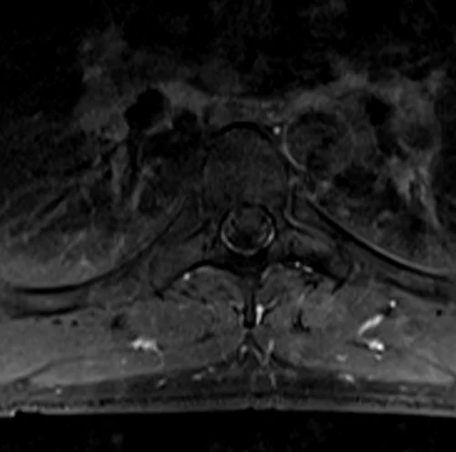 thorasic spine axial t1 fat sat post contrast image 3 - MRI