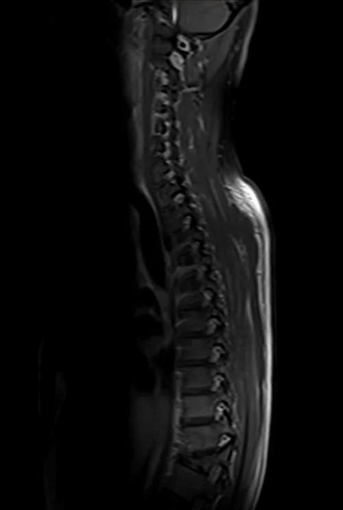 thorasic spine sagittal post contrast image 1 - MRI