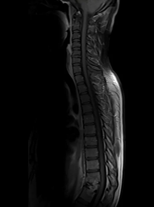 thorasic spine sagittal post contrast image 2 - MRI