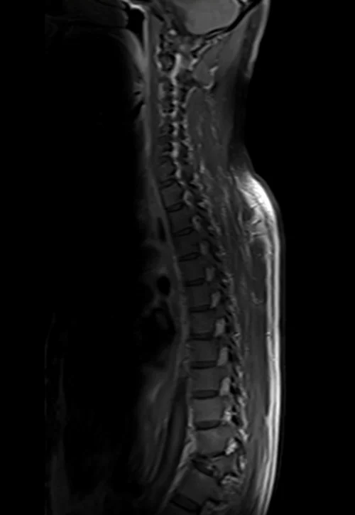 thorasic spine sagittal post contrast image 3 - MRI