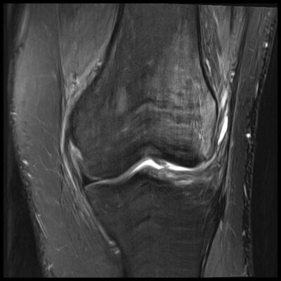 MRI motion artifact knee