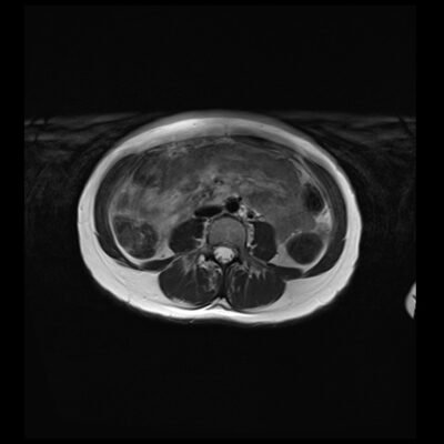 MRI motion artifact abdomen t2