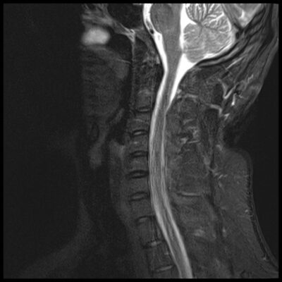 MRI motion artifact c spine