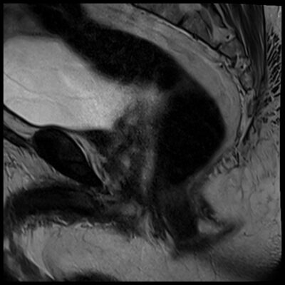 MRI motion artifact pelvis sagittal