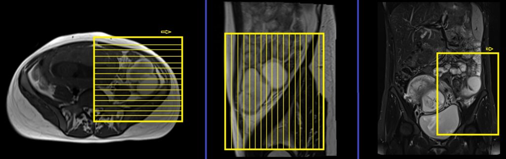 Adnexal Masses in Pregnancy MRI coronal SFOV planning and protocol