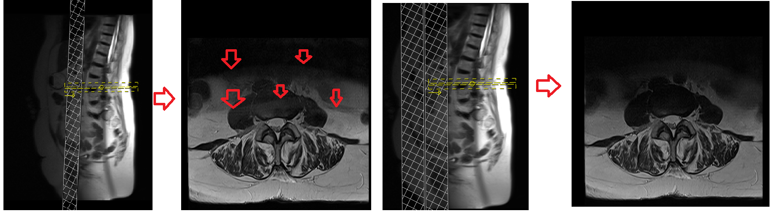 MRI saturation band artifacts