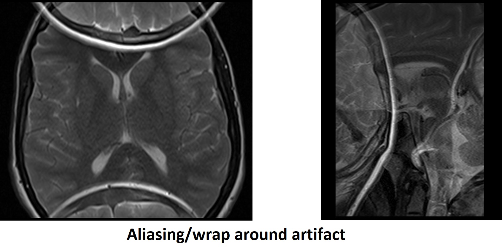 Frequency wrap-around - Questions and Answers ​in MRI