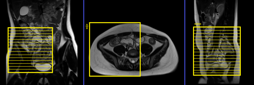 Appendix mri planning and protocol axial small FOV planning