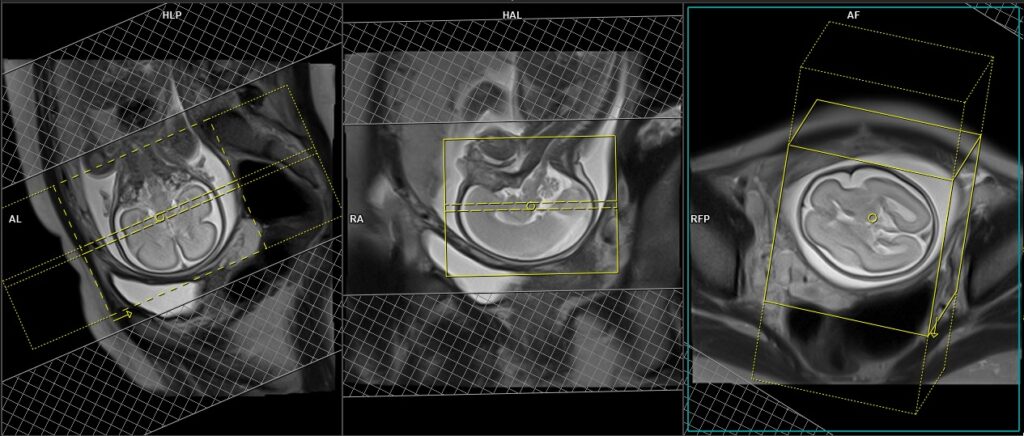 Fetal brain MRI planning of axial images