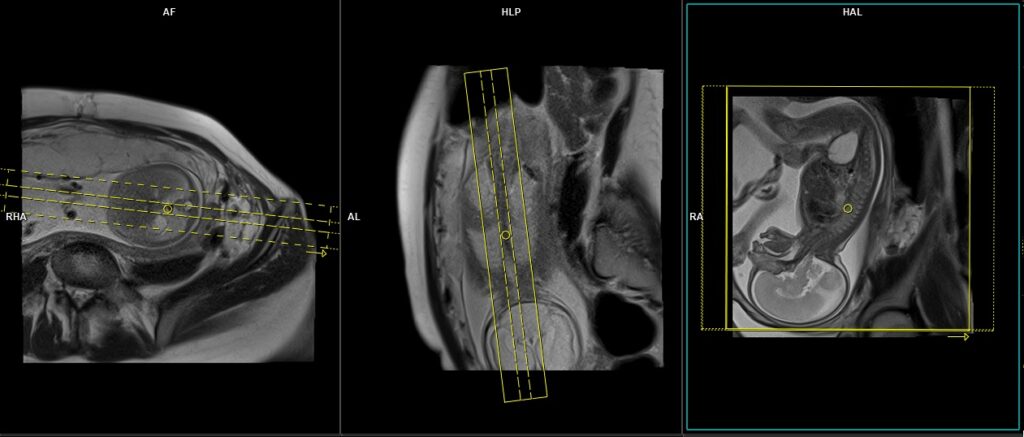 Fetal spine MRI planning of sagittal image
