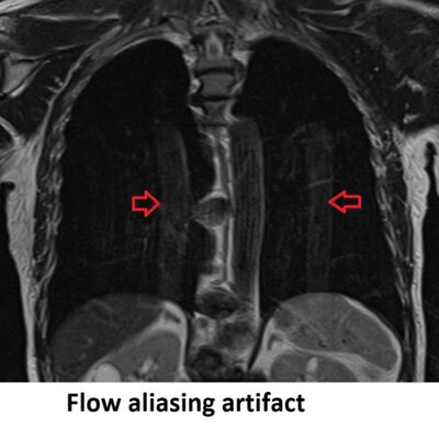 Flow Aliasing artifact MRI