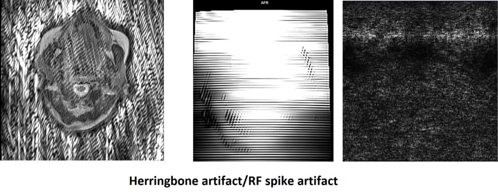 Herringbone artifact, also known as the spike artifact