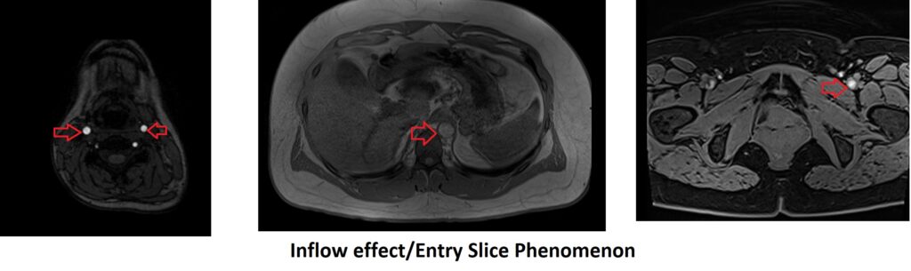 Inflow effect Entry Slice Phenomenon artifact MRI