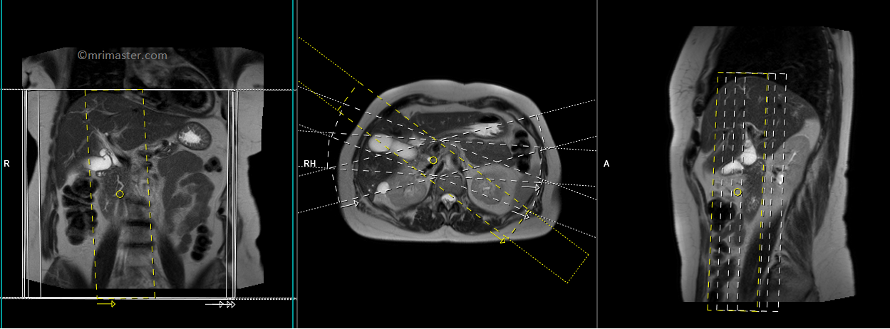 MRCP Planning |MRCP Protocols | Indications for MRI ...