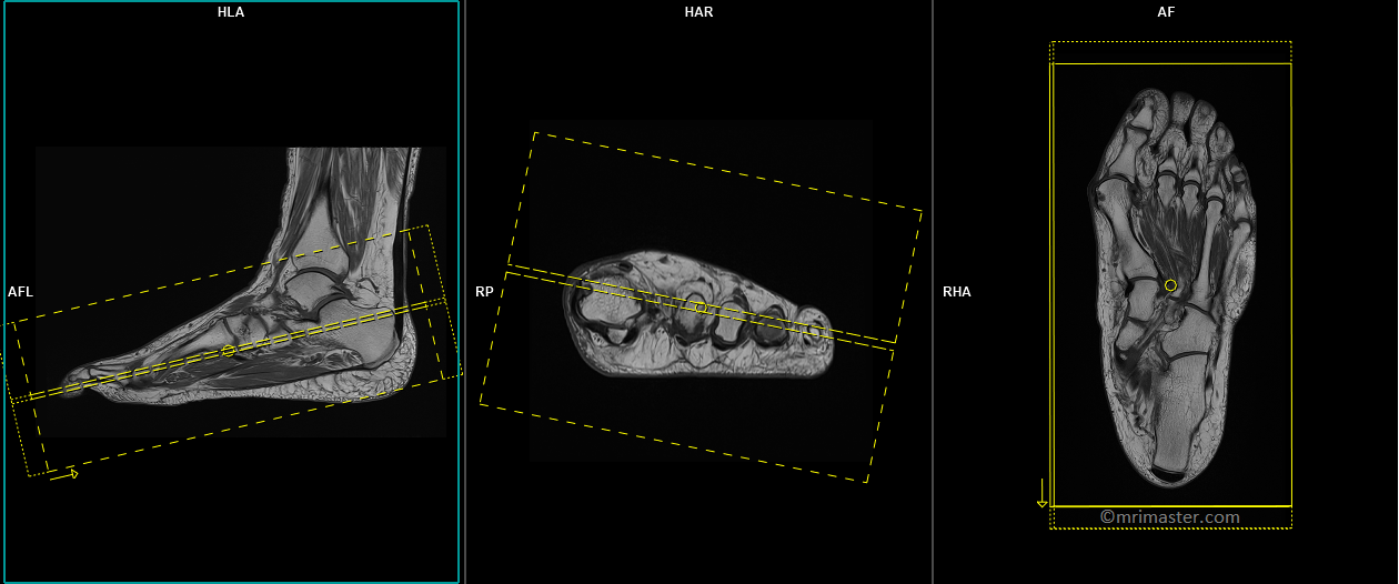 Foot MRI Protocols and Planning Indications for MRI Foot Scan