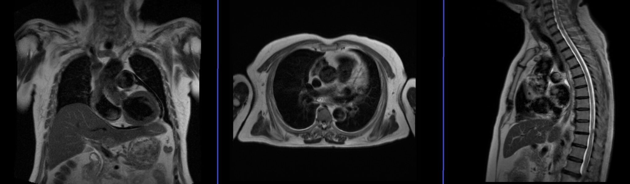 Chest MRI Protocols and Planning | Indications for MRI Chest Scan