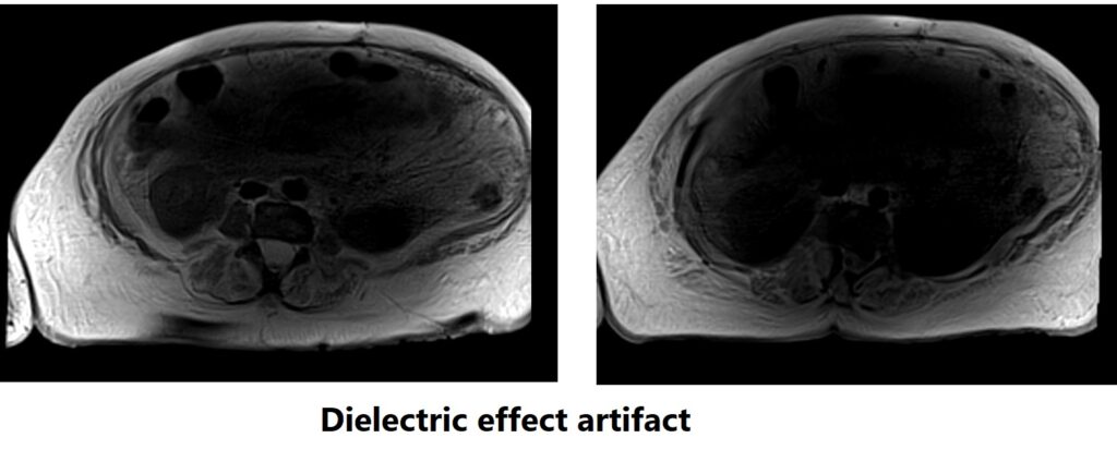 MRI dielectric effect artifact