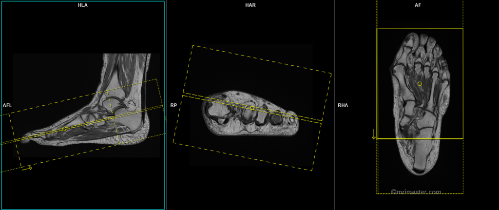 MRI forefoot planning and protocol of coronal scans