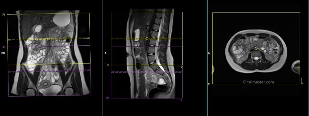 MRI small bowel (enterography) axial planning