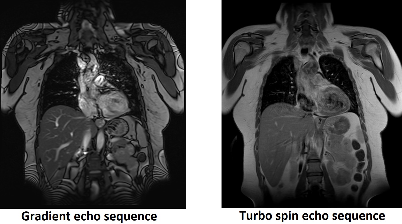 Moire Fringes | Moire Fringes MRI Artifact