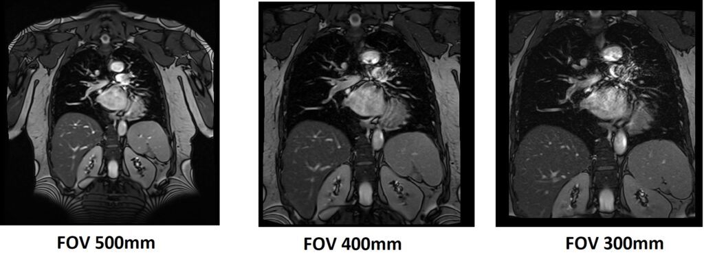 Moire Fringes | Moire Fringes MRI Artifact