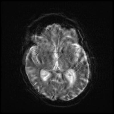 Motion artifact DWI MRI