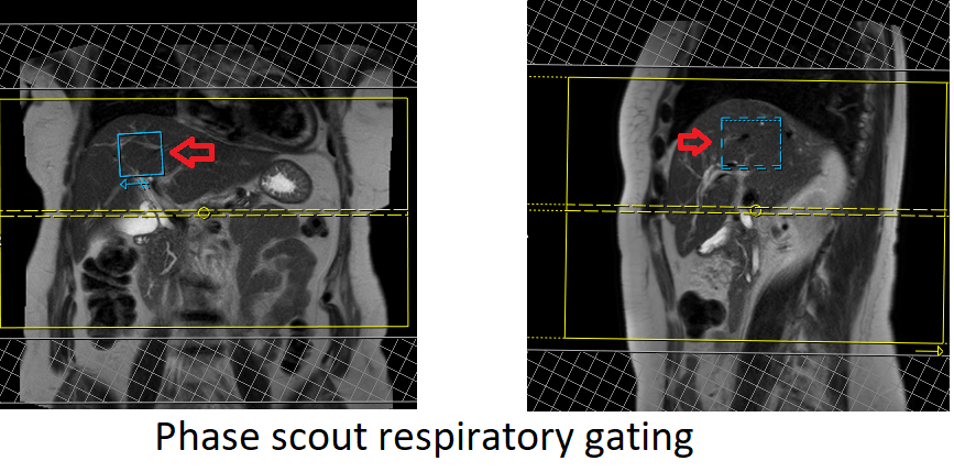 Phase scout respiratory gating MRI