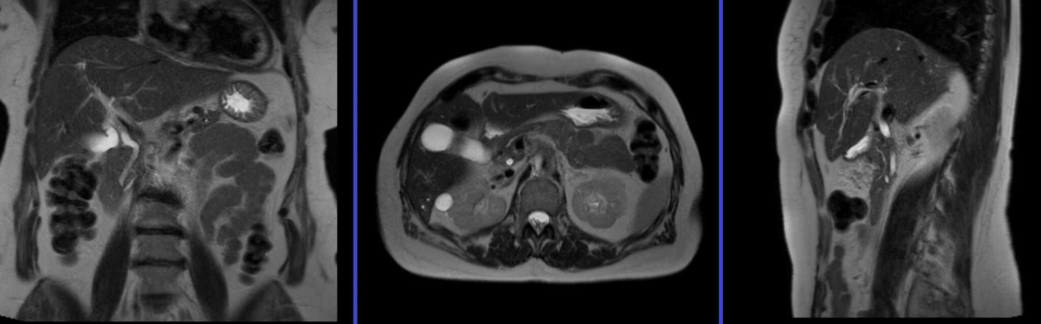 MRCP Planning |MRCP Protocols | Indications for MRI ...