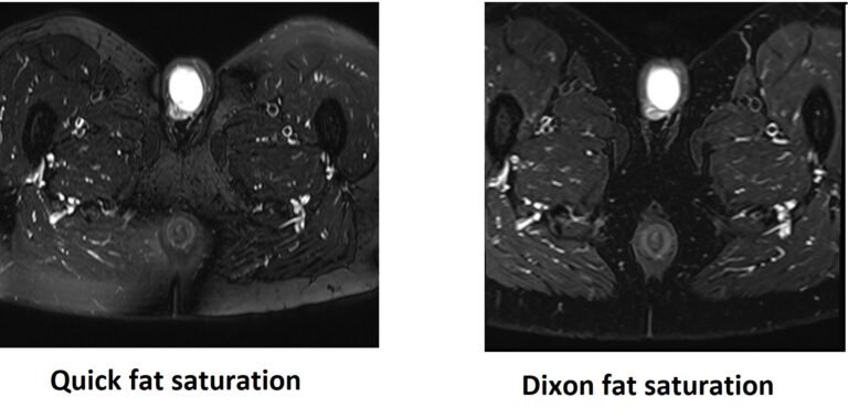 Fat Signal fat suppression artifact MRI | Lipid suppression artifact