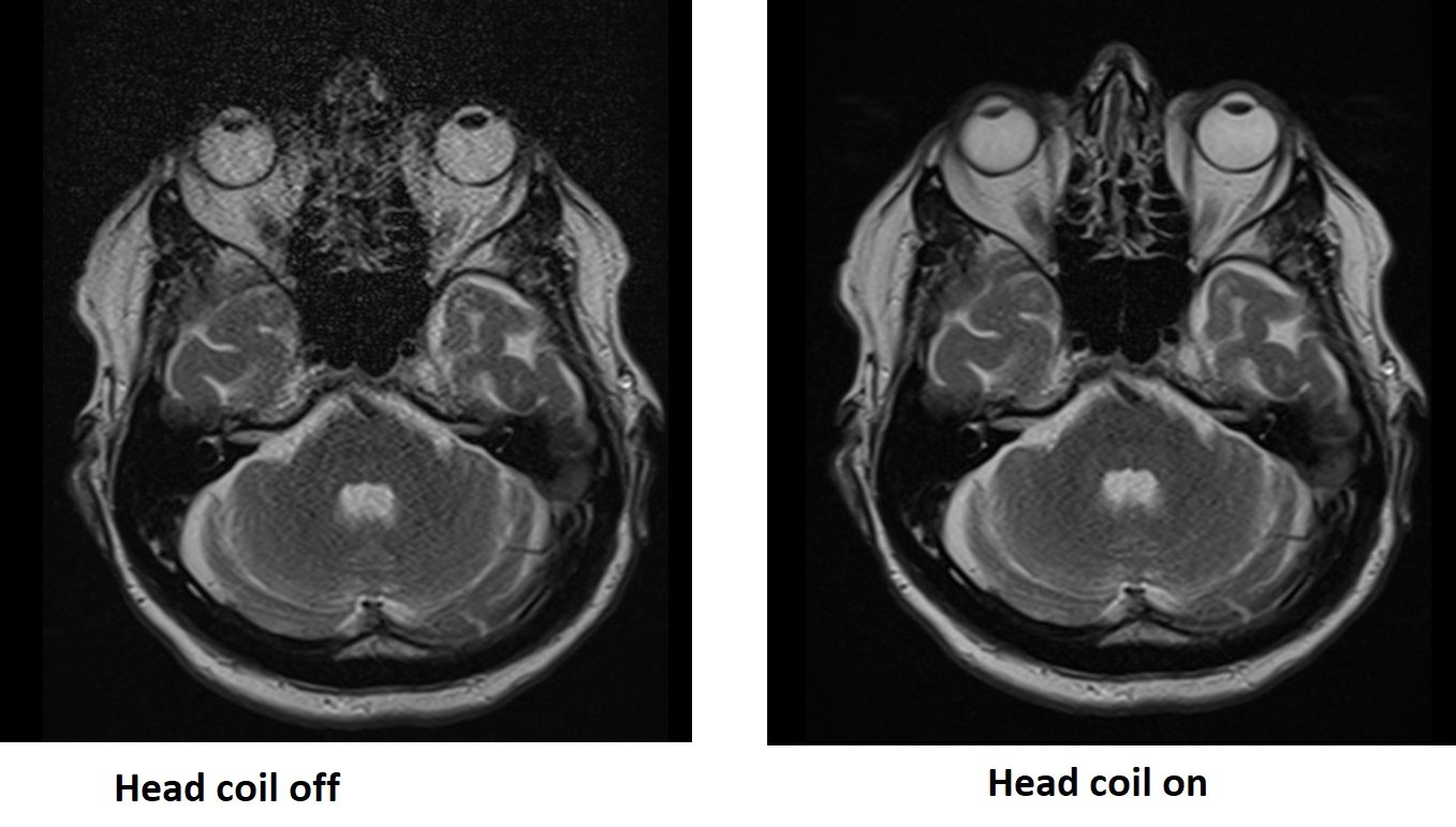 MRI Signal-to-noise ratio related artifact | SNR artifacts
