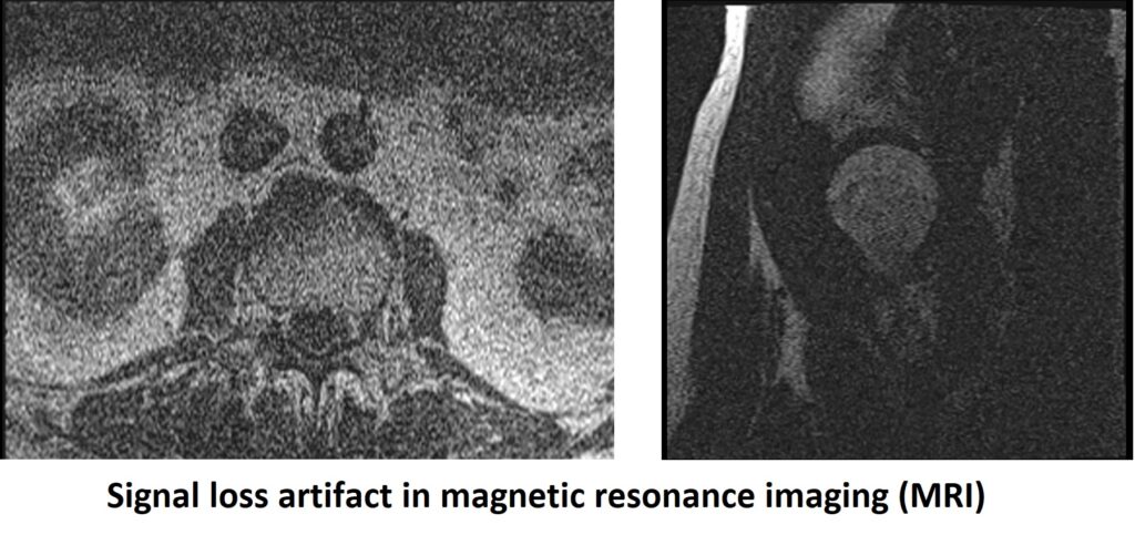 Signal loss artifact in magnetic resonance imaging (MRI)
